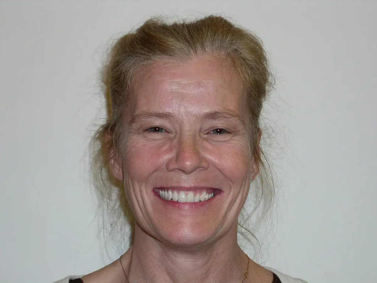 Case 10 — after treatment at Capital Dental Group