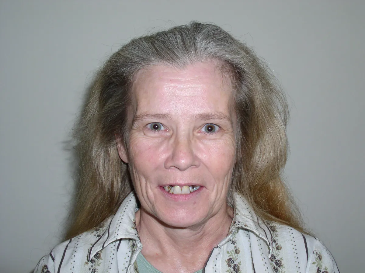 Case 10 — before treatment at Capital Dental Group