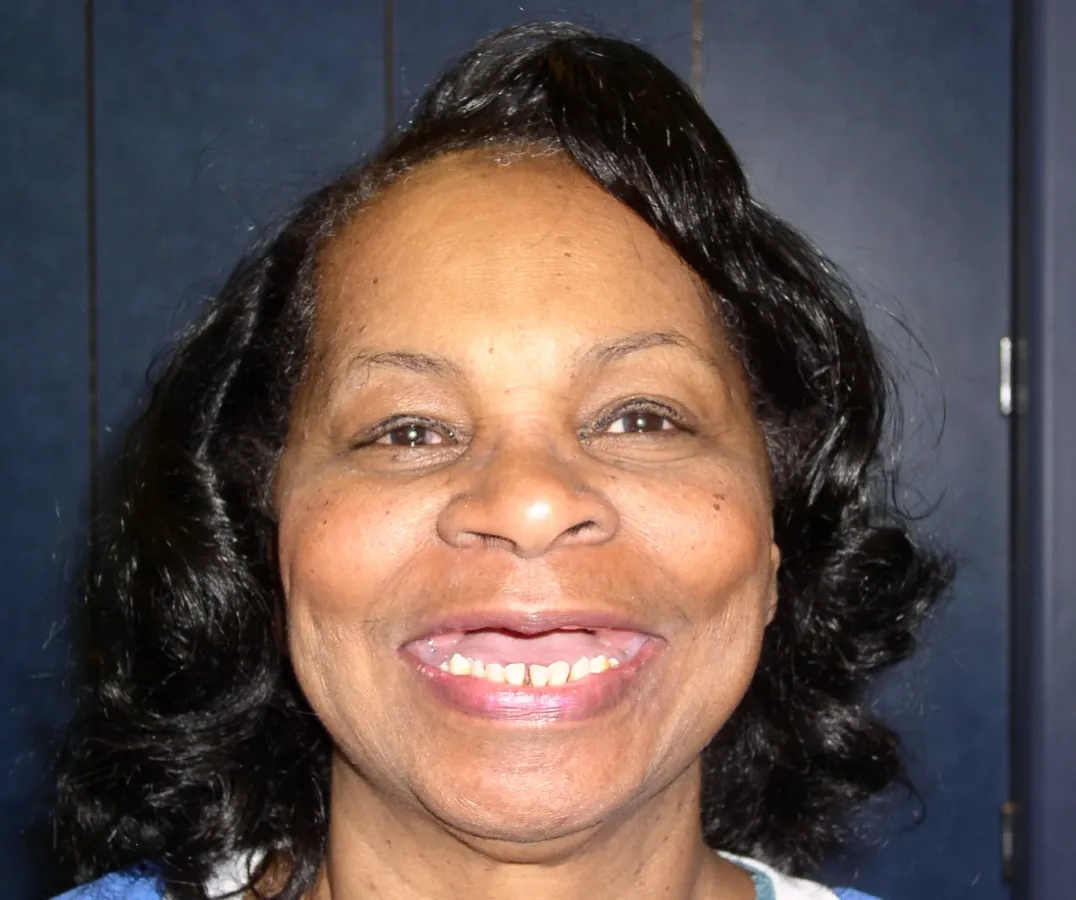 Case 4 — before treatment at Capital Dental Group