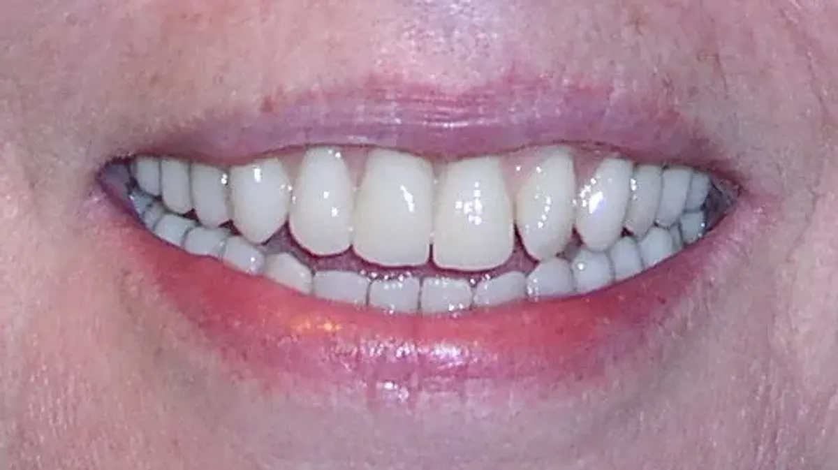 Case 5 — after treatment at Capital Dental Group