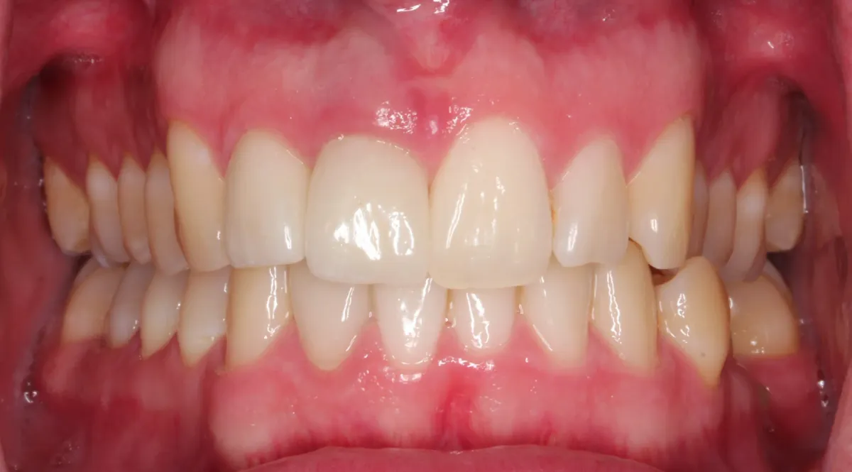 Case 6 — after treatment at Capital Dental Group