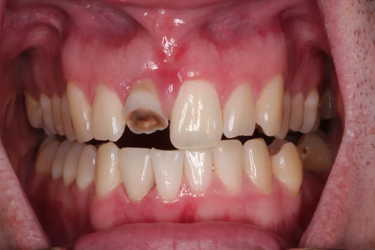 Case 6 — before treatment at Capital Dental Group