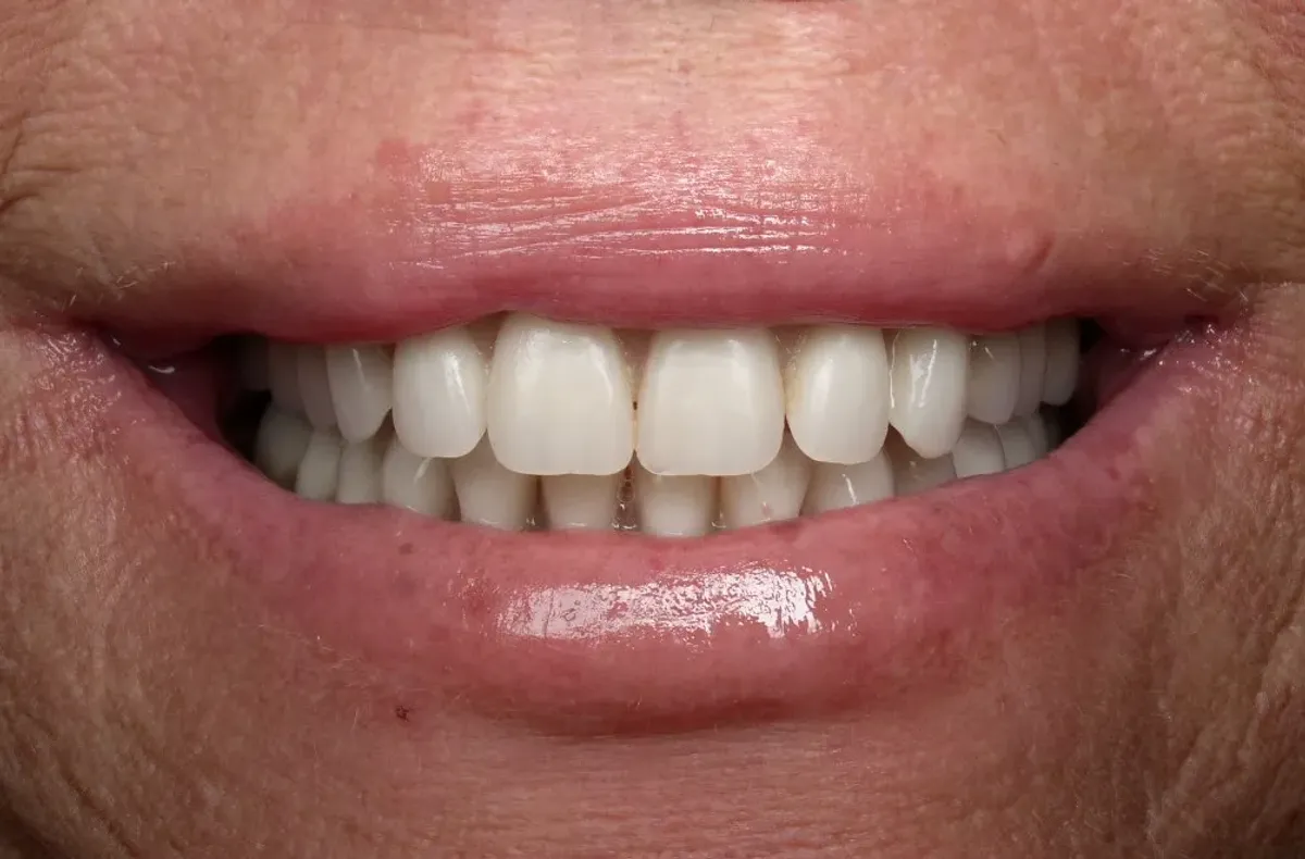 Case 9 — after treatment at Capital Dental Group