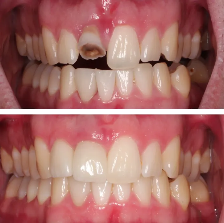 Before and after implant-restored smile at Center for Implant Dentistry
