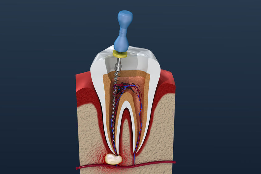 3D Rendering of Root Canal Treatment