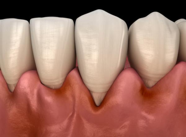 An illustration of teeth and gums that have been inflamed by disease