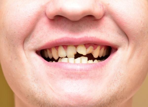 A man shows off a smile where several teeth are chipped or broken