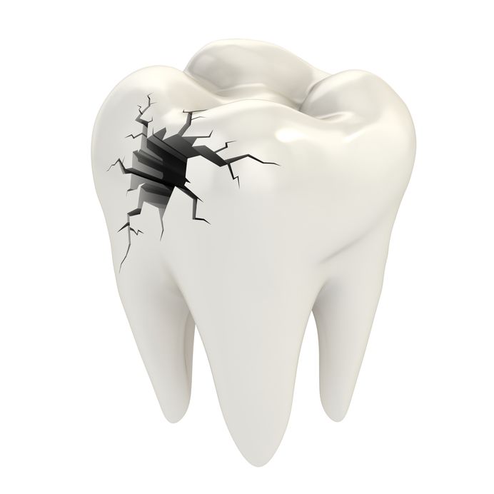 A 3D rendering of a cracked tooth